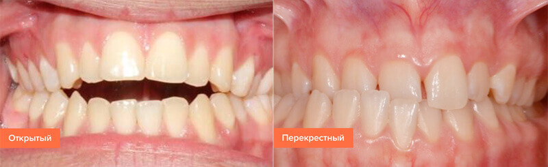 Исправление неправильного прикуса зубов у взрослых