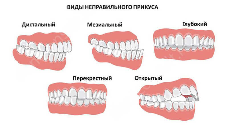 Можно ли исправить прикус у взрослого человека